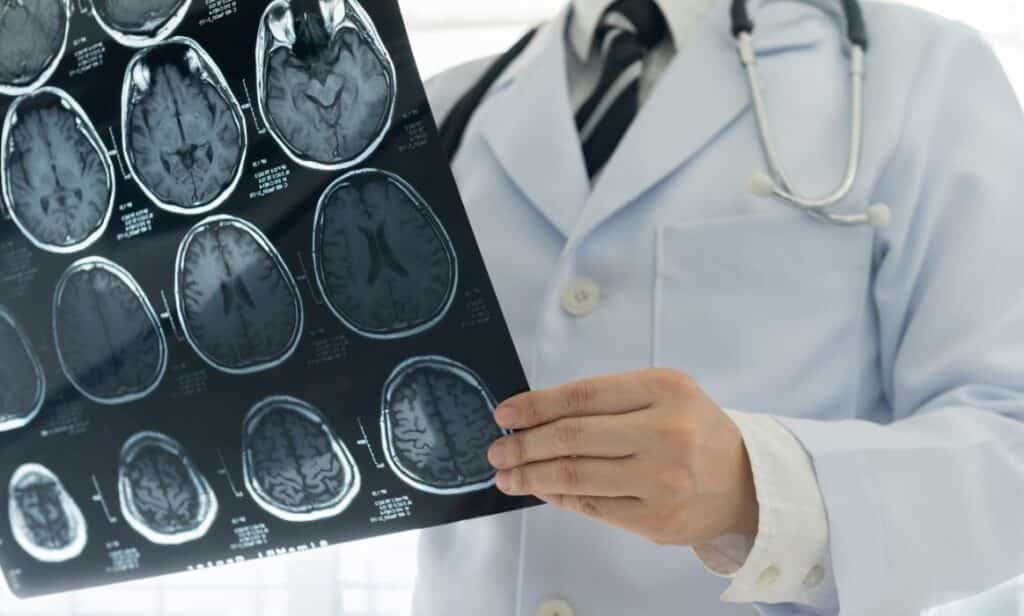 Quelle est l'espérance de vie avec la maladie d’Alzheimer