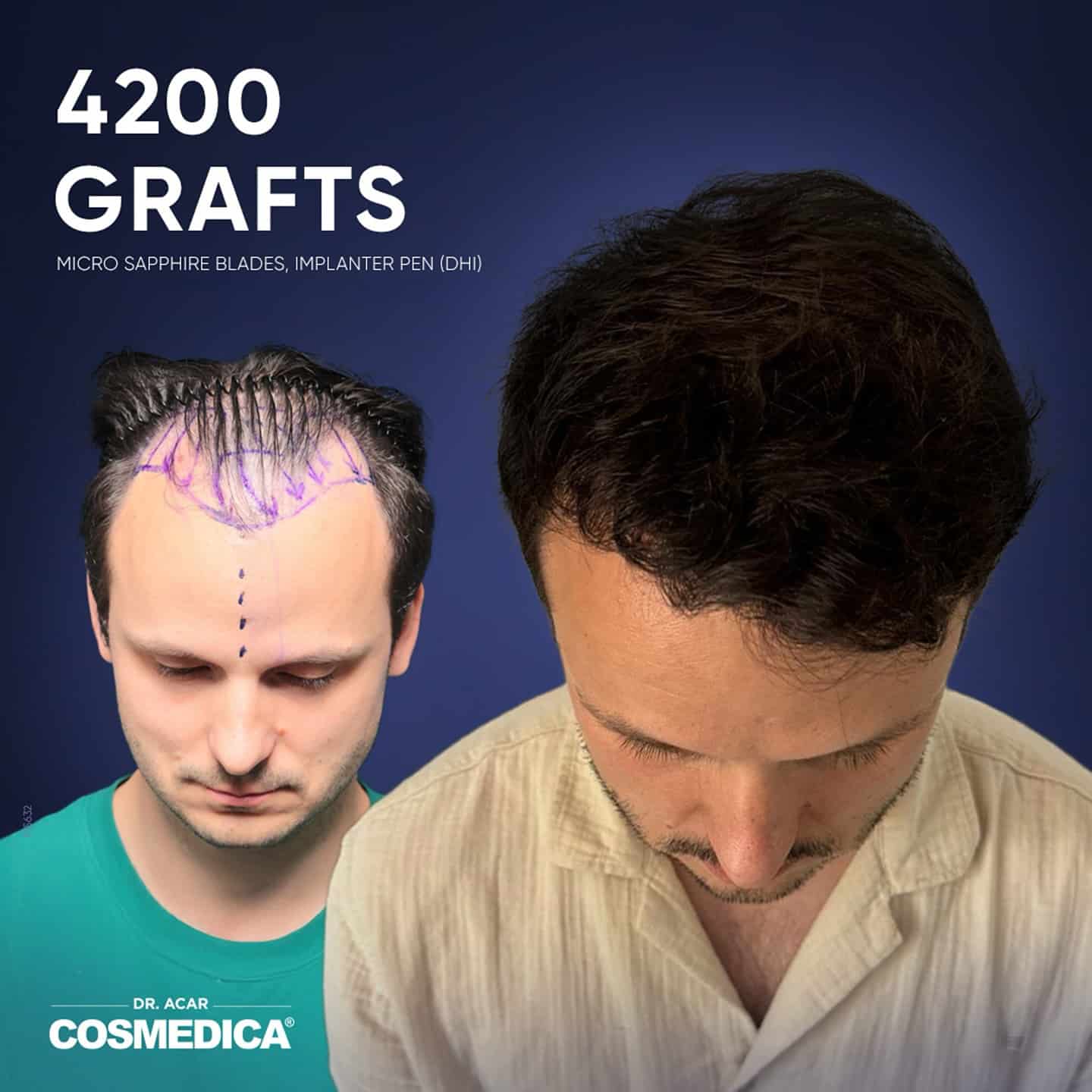 Greffe Cheveux Avant Apres